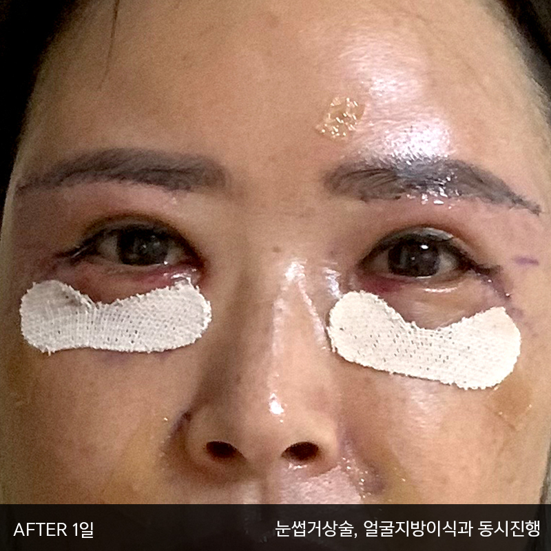 중년눈밑지방수술 아직 모르신다면 관련 이미지 3