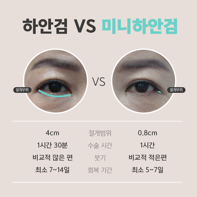 중년눈성형후기 눈 밑이 달라지니까 인상이 확 바뀌었어요 관련 이미지 4