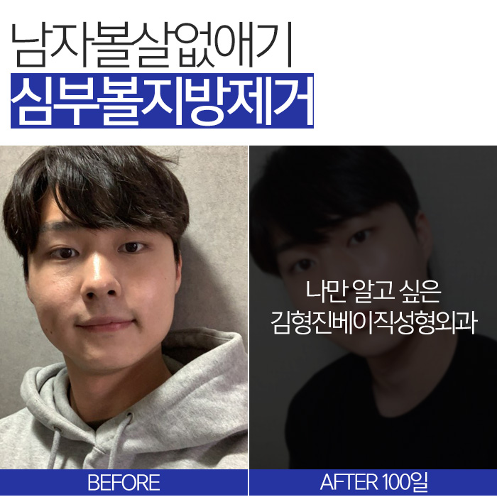 남자볼살없애기 실패한 이유, 아직 몰라요? 관련 이미지 3