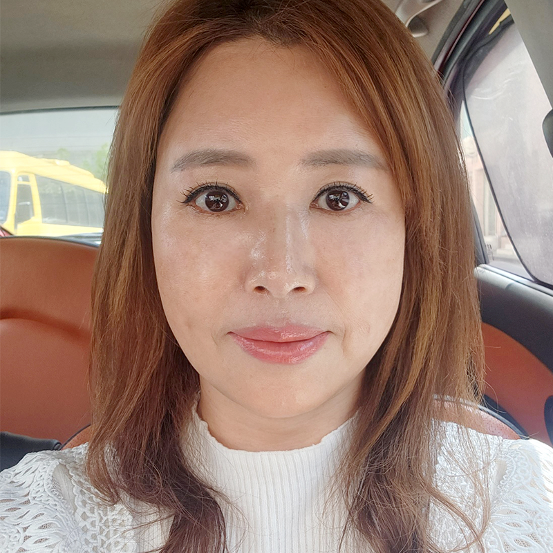 중년눈밑지방수술 어떤 방법이 있냐면요 관련 이미지 1