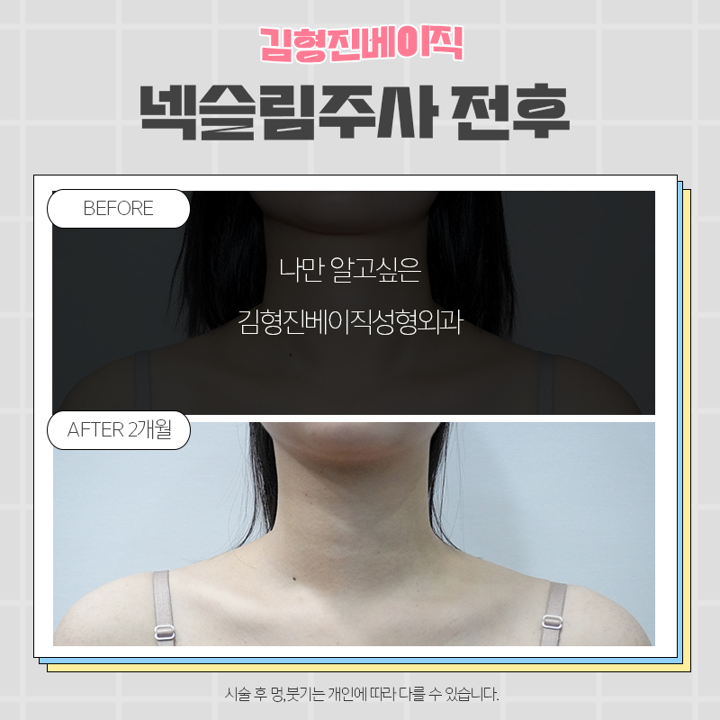 넥슬림보톡스전후 궁금하신분!? 관련 이미지 3