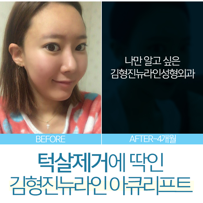 남자턱살제거 이렇게 해야지 관련 이미지 2