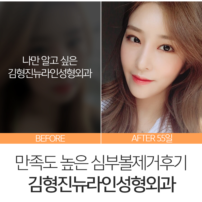 심부볼제거후기 내 맘에 아주 쏙 들어 관련 이미지 2
