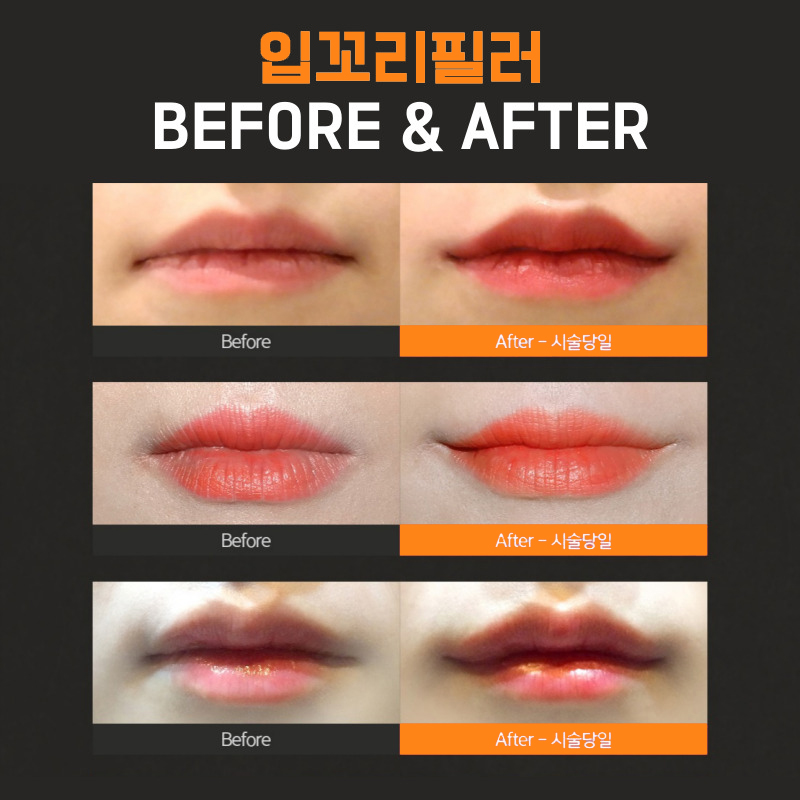 입꼬리필러 후회 돼요... 왜 이제야 했는지 관련 이미지 6