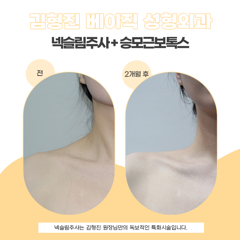 여리여리한 실루엣의 비밀, 넥슬림주사후기 관련 이미지 4