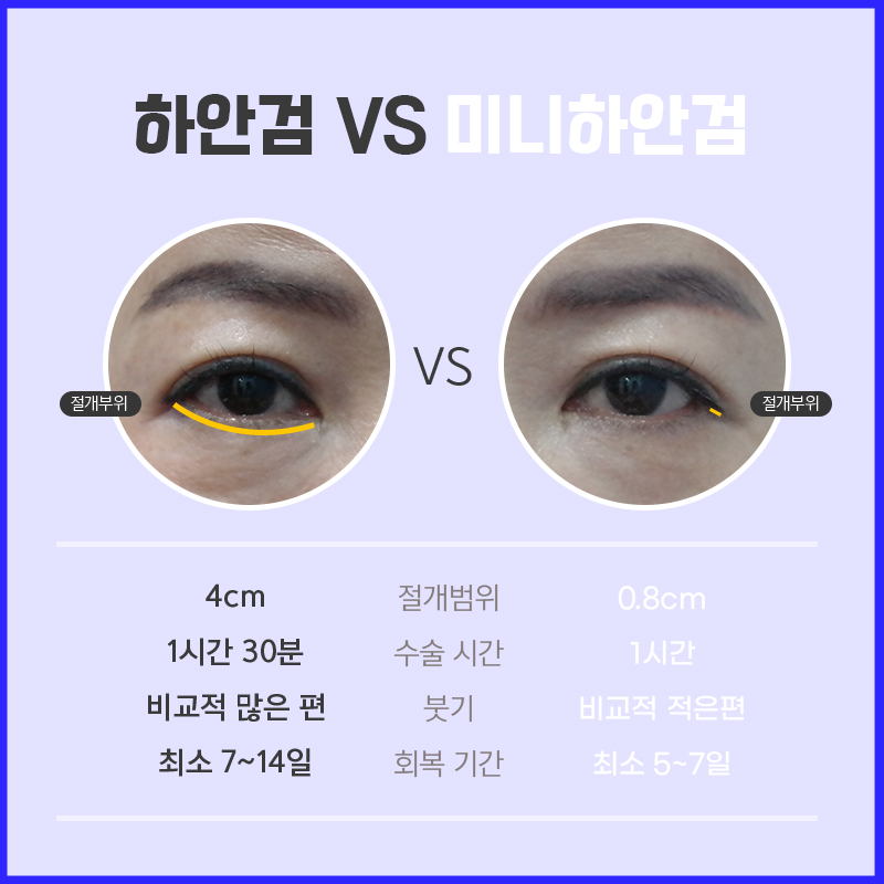중년하안검으로 나이 들어 보이는 원인 해결했어요 관련 이미지 4