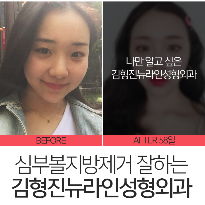 심부볼가격 아직도 싼 곳만 찾아요? 관련 이미지 2