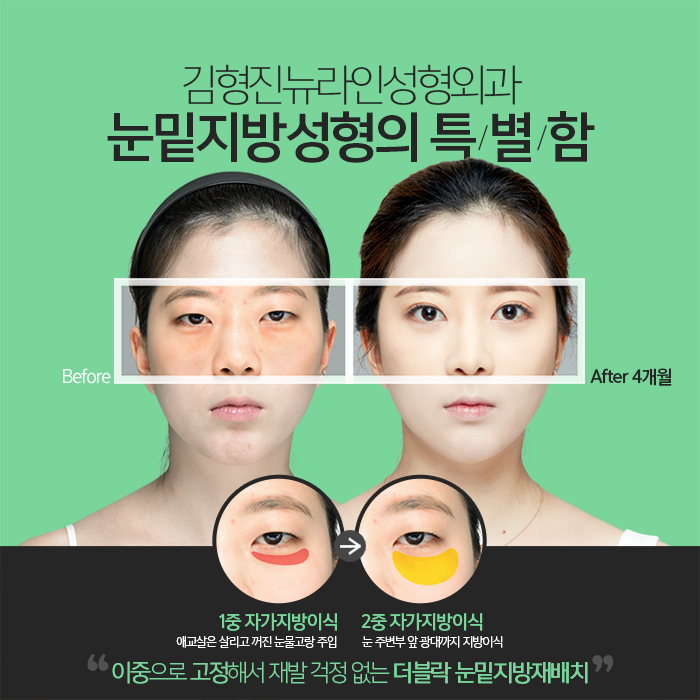눈밑지방재배치멍 걱정? 김형진원장이라면 관련 이미지 4
