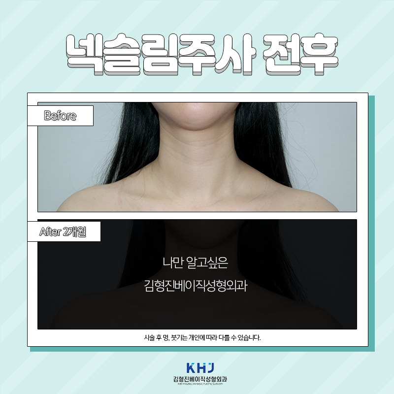 넥슬림주사전후 궁금하셨다면 보고 가세요! 관련 이미지 3