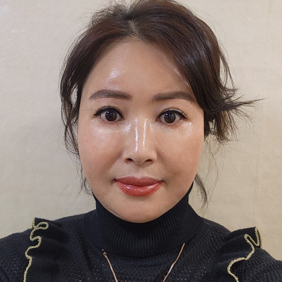 Mini Lower Eyelid Surgery Review: When the area under the eyes brightens, you really do look younger image 1