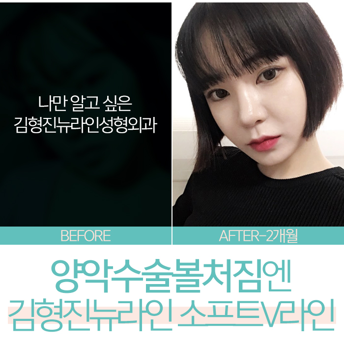 안면윤곽후리프팅 정답이라고 확신해요? 관련 이미지 3