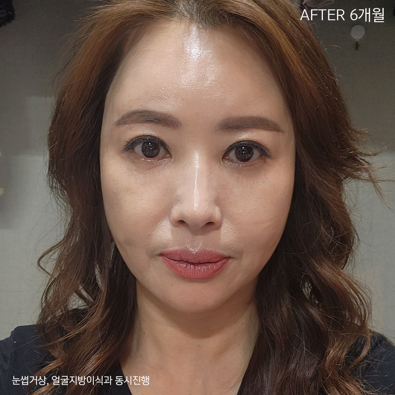 중년눈밑성형 부담없는이유 바로 여기에! 관련 이미지 6