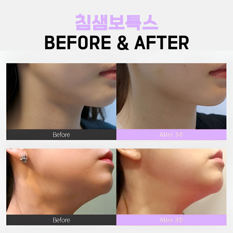 의외로 사람들이 모르는 침샘비대증원인? 관련 이미지 6