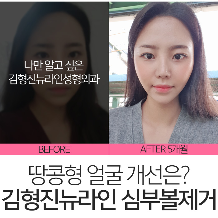 땅콩형얼굴 고민만 하고 있나요? 관련 이미지 3