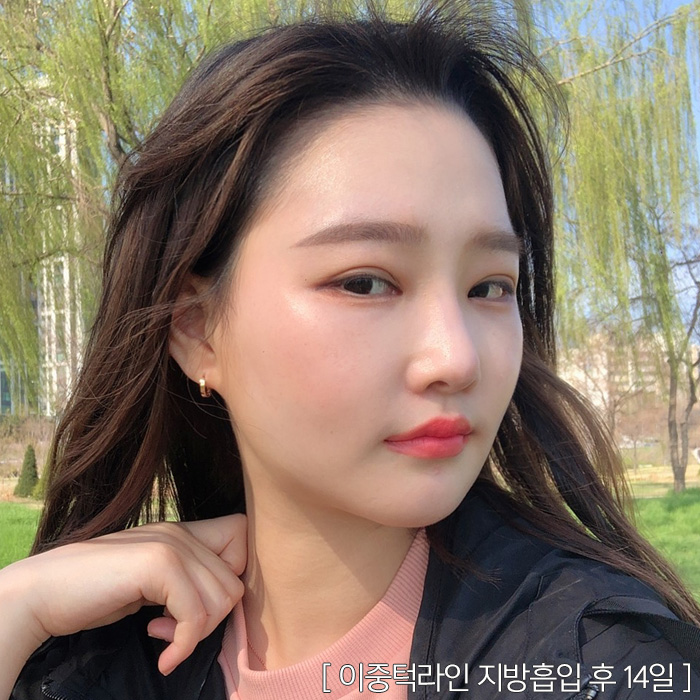 턱지방분해주사 효과 못 보지 않았어요? 관련 이미지 2