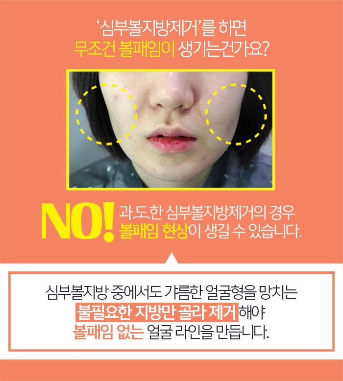 심부볼패임 어떻게 하느냐에 따라 달라요 관련 이미지 4