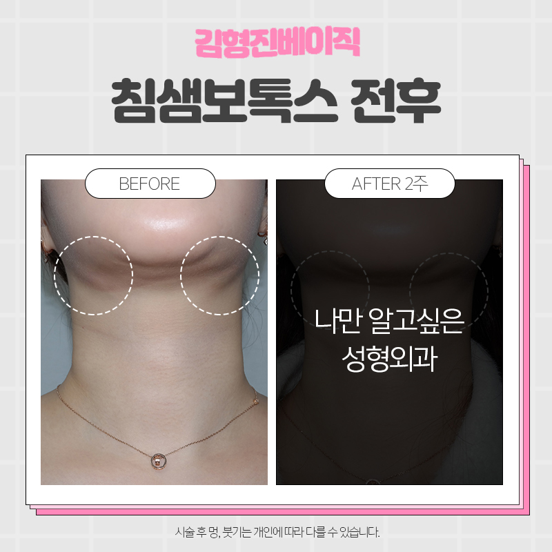 침샘보톡스잘하는곳 입소문 나는 곳은 다 이유가 있습니다 관련 이미지 5
