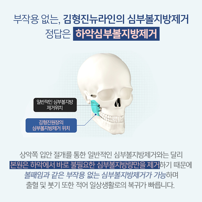 심부볼부작용 김형진뉴라인성형외과에서는 걱정 뚝 관련 이미지 3