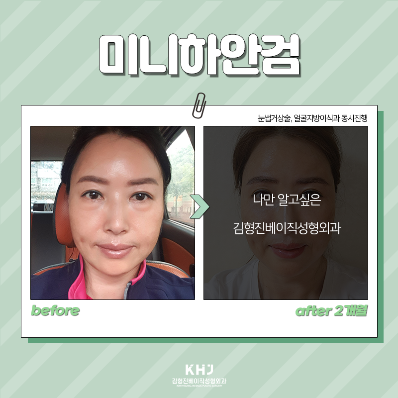 중년눈밑지방수술 어떤 방법이 있냐면요 관련 이미지 4