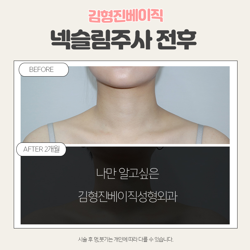 웨딩시술은 김형진베이직에서! 관련 이미지 2