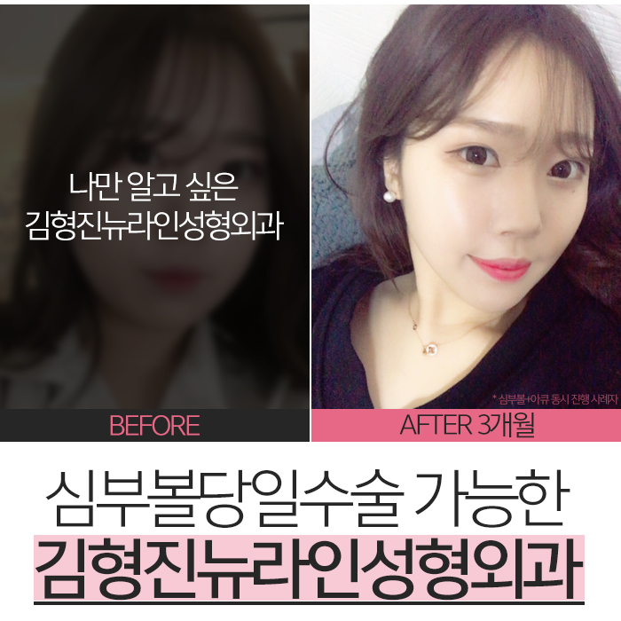 심부볼당일수술 그리고 만족한 결과! 관련 이미지 6