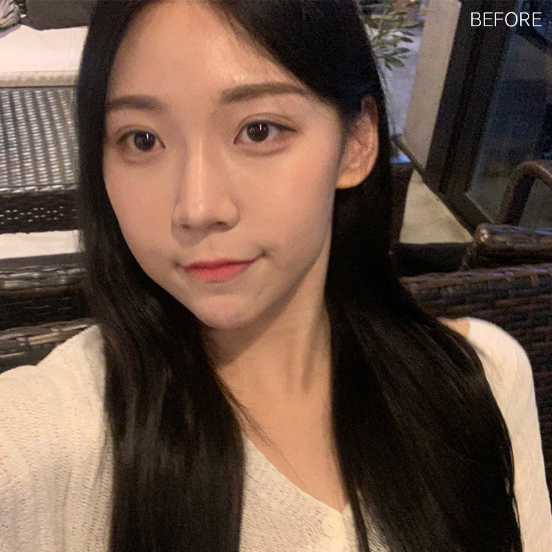 심부볼  보톡스 효과 없었던 건 관련 이미지 2