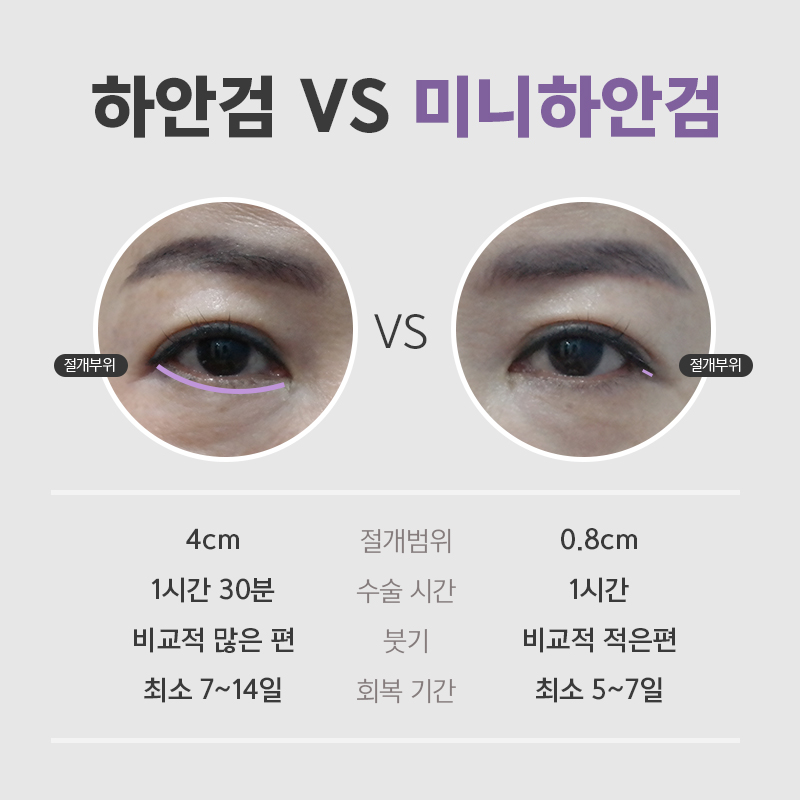미니하안검회복기간 어느정도냐구요? 관련 이미지 2