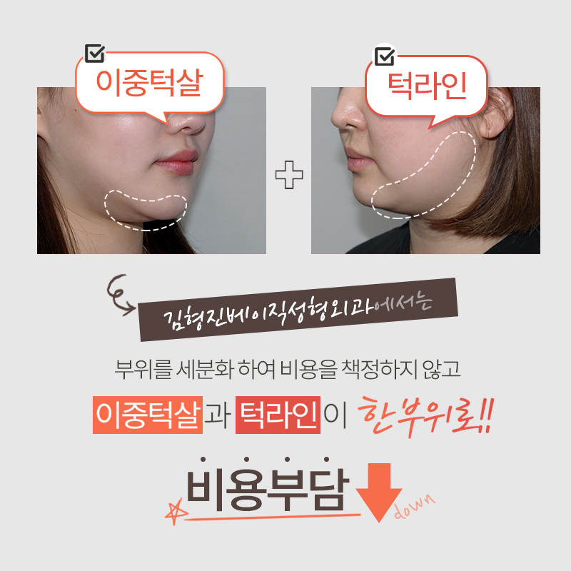 이중턱지방흡입비용 부담되신다구요? 관련 이미지 2