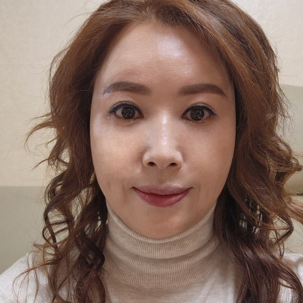 Middle-Aged Under-Eye Surgery Review: I Look Younger After Mini Lower Blepharoplasty image 1