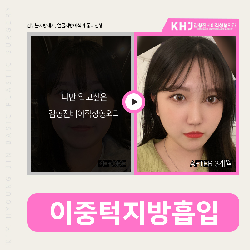 이중턱지방흡입전후 차이가 큰 김형진베이직 관련 이미지 3