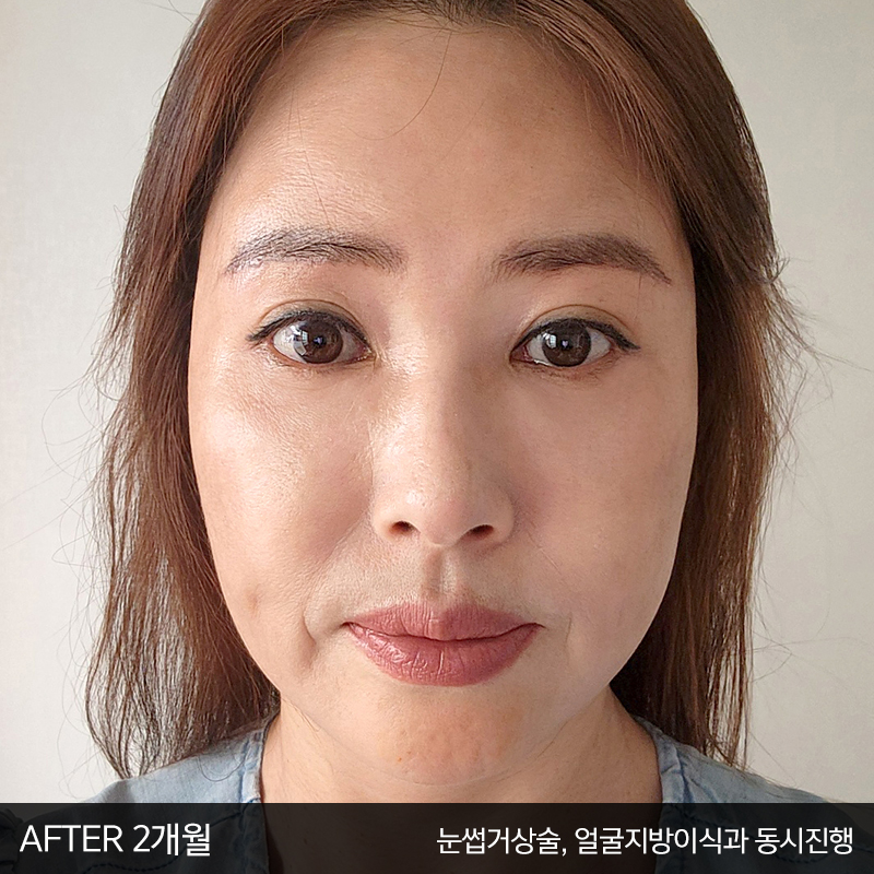 중년눈밑처짐 해결방법은 관련 이미지 6