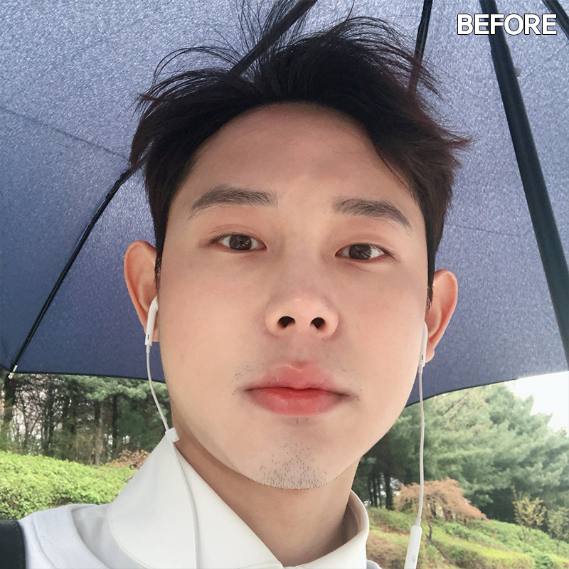 남자심부볼제거? 당연히 가능하죠! 관련 이미지 2