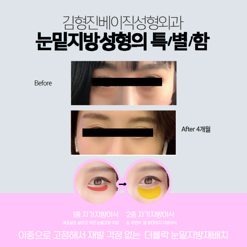 눈밑지로 다크서클과 피곤한 인상 개선했어요 관련 이미지 5
