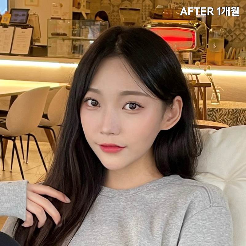 심부볼제거수술을 왜 받냐구요? 관련 이미지 5