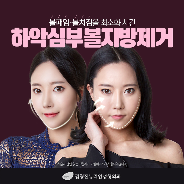 심부볼지방제거성형외과 김형진뉴라인, 알죠? 관련 이미지 3