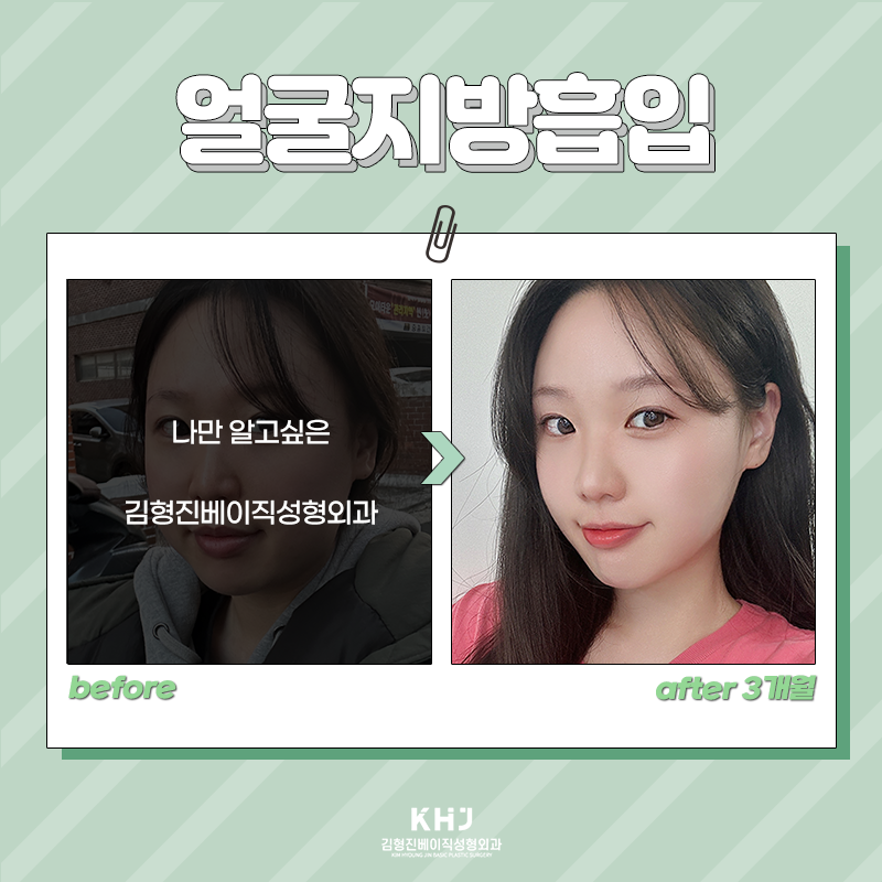 얼굴지방흡입전후 이렇게나 좋다구? 관련 이미지 4