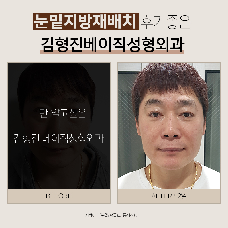 눈밑지방재배치후기 봐주실 분 관련 이미지 5