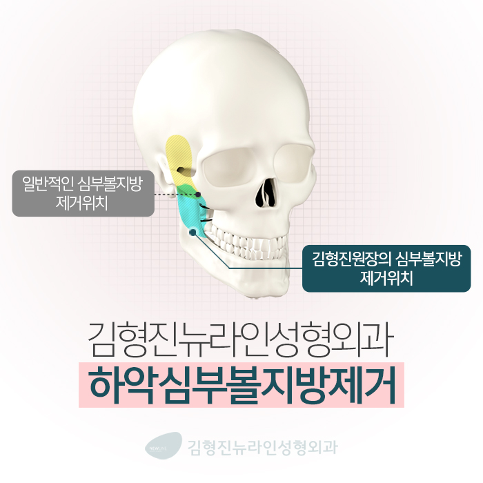 심부볼제거후기 진짜를 보여주지 관련 이미지 3