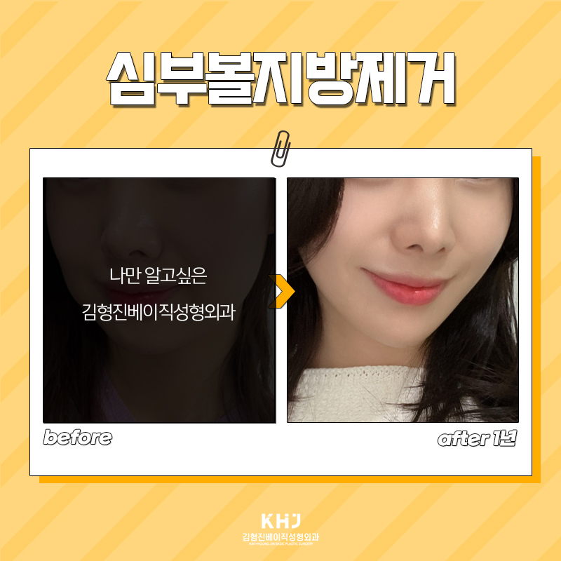 나만 알고 싶던 심부볼없애는방법 언제 글 내릴지 몰라요 관련 이미지 6