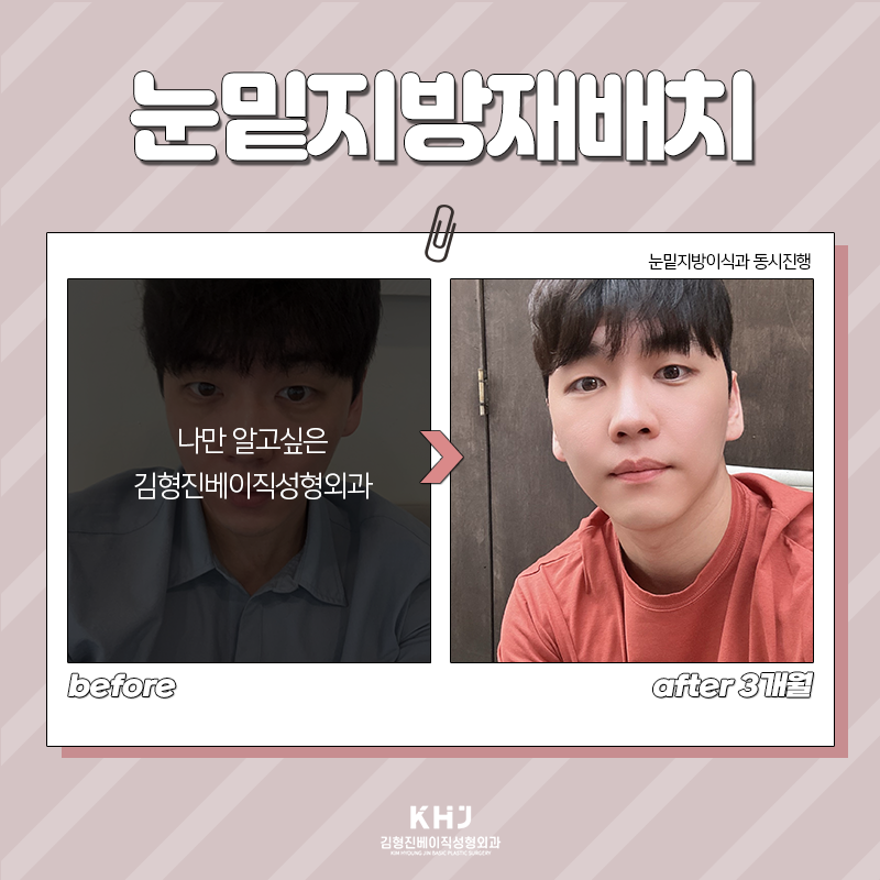 Take a look at the before-and-after of under-eye fat repositioning! image 4