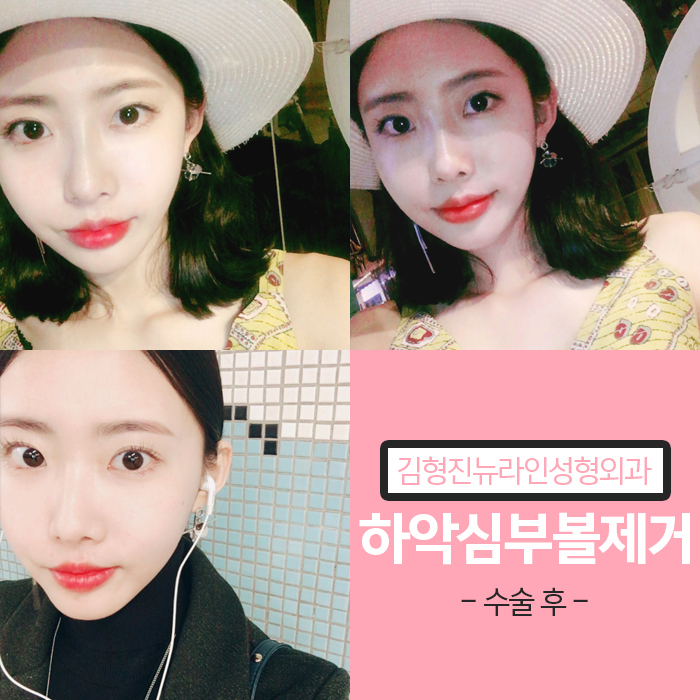 하악심부볼지방제거 안전과 부작용을 생각한다면 관련 이미지 6