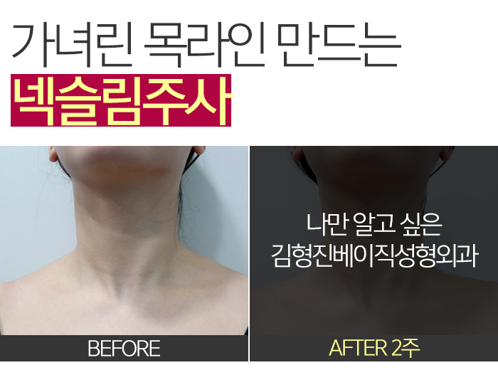 넥라인보톡스 진짜 해야 할때 (a.k.a 김형진베이직 넥슬림주사) 관련 이미지 3