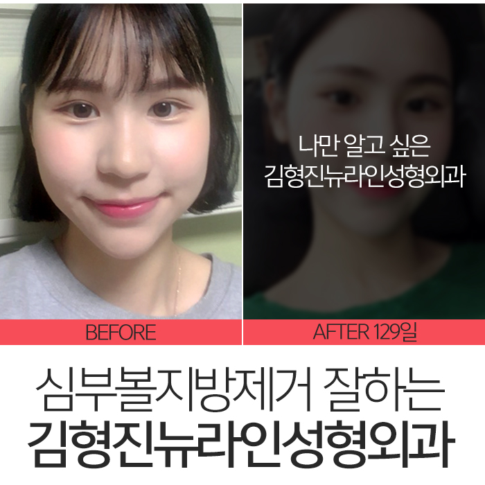 심부볼가격 아직도 싼 곳만 찾아요? 관련 이미지 7