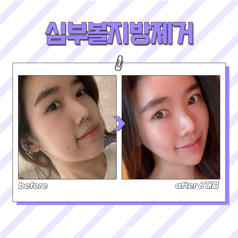 무겁고 처진 인상, 심부볼제거술로 해결해요 관련 이미지 5