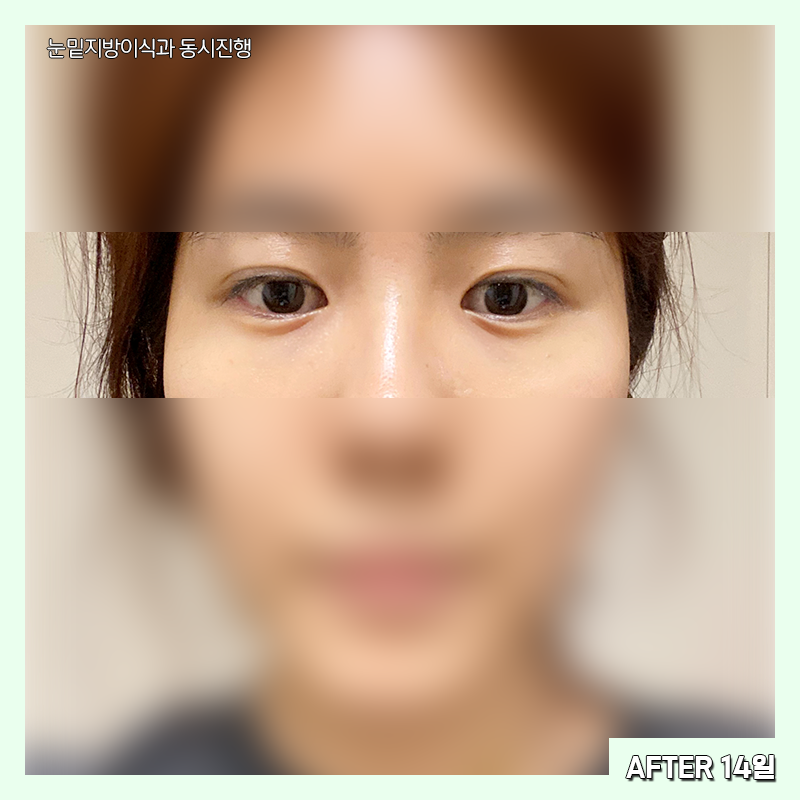 눈밑지방재배치전후 확인하고 가세요~! 관련 이미지 5
