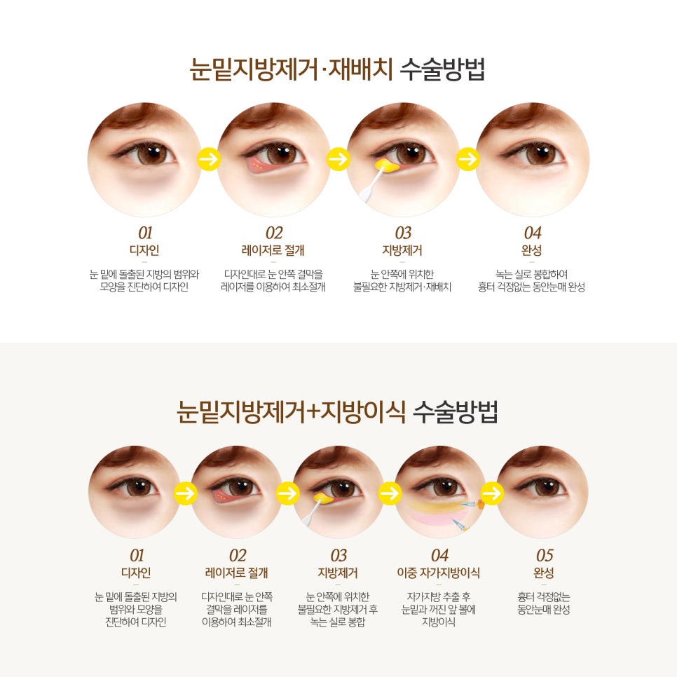 눈밑지수술 효과 대박이에요ㅠㅠ 관련 이미지 5