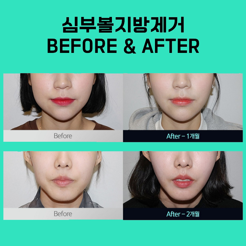 심부볼제거잘하는곳에서 정교하게 깊은 지방층까지 해결해요 관련 이미지 5