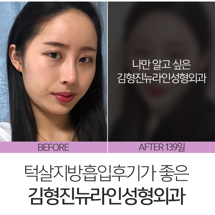 턱살지방흡입후기 확실한 곳 찾아요? 관련 이미지 7
