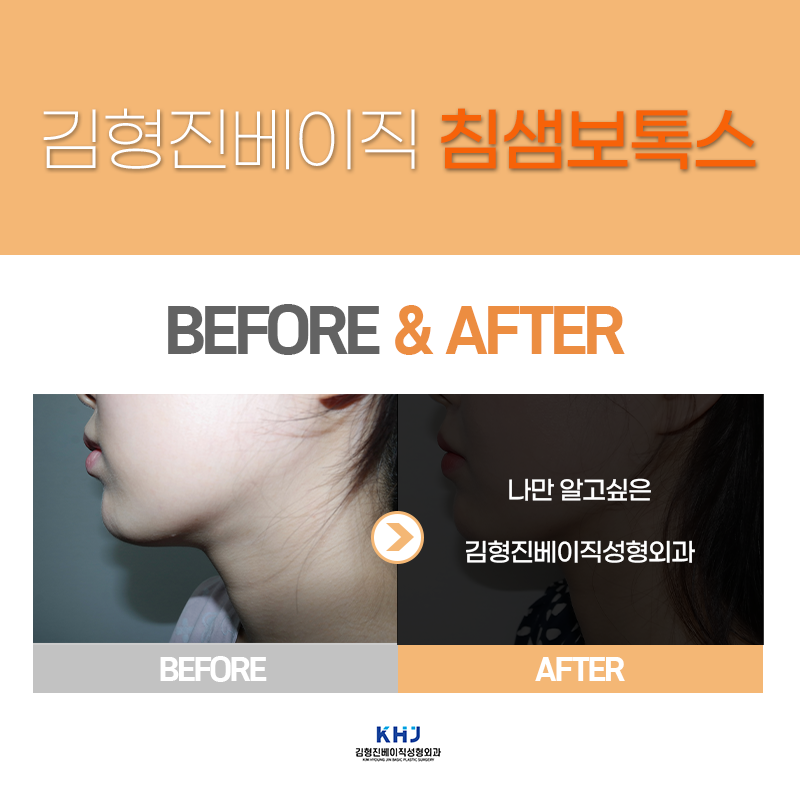 침샘보톡스시술주기 체크해야 하는 이유? 관련 이미지 3