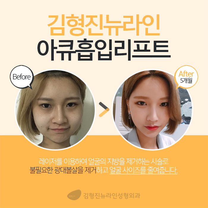 광대살지방흡입 이렇게 하는 거였어? 관련 이미지 3